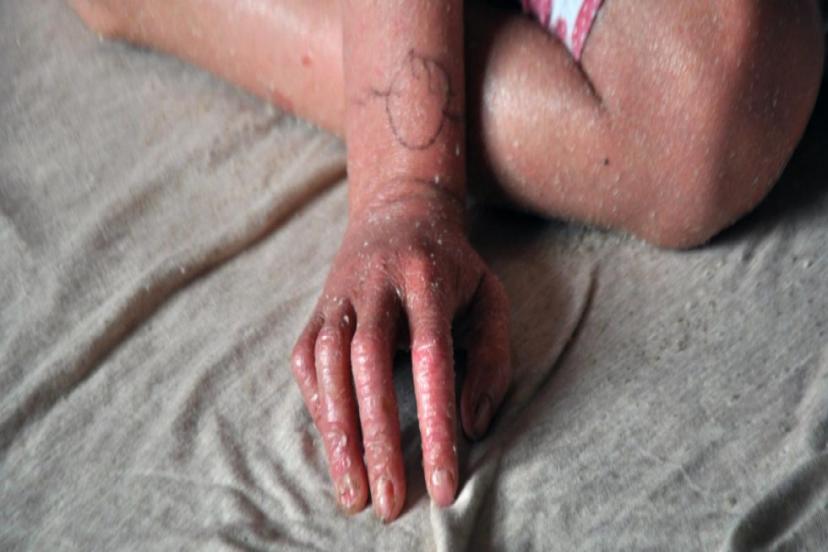 DÜNYA GENELİNDE YAKLAŞIK 400 MİLYON İNSAN NADİR HASTALIKLARLA MÜCADELE EDİYOR